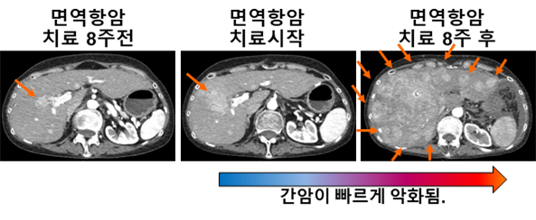 간암2.png