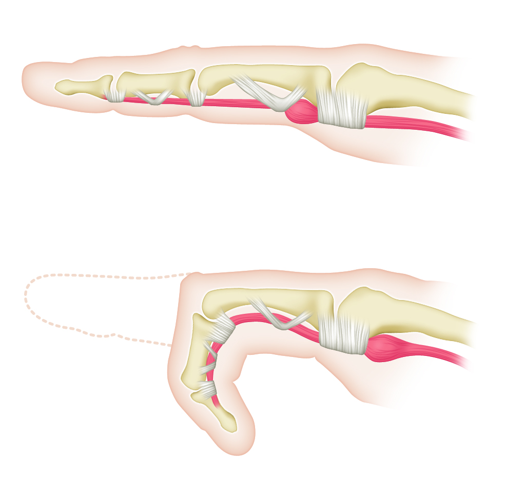 [사진설명] 손가락에 반복적으로 부담이 누적될 경우 손가락 힘줄에 염증이 생겨 방아쇠수지증후군을 일으킬 수 있다..jpg