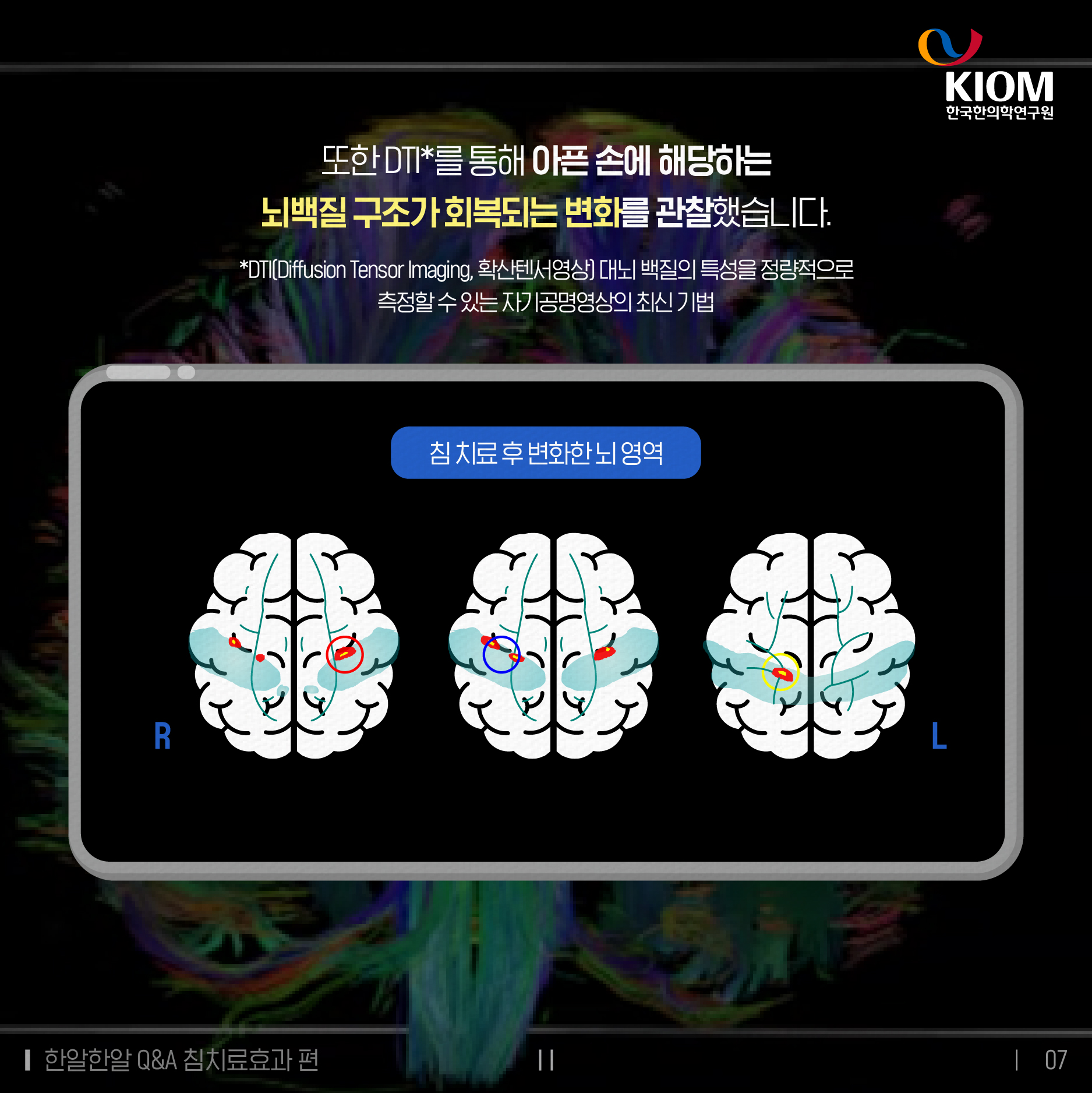 한알한알 Q&amp;A_침치료효과-2차-07.jpg