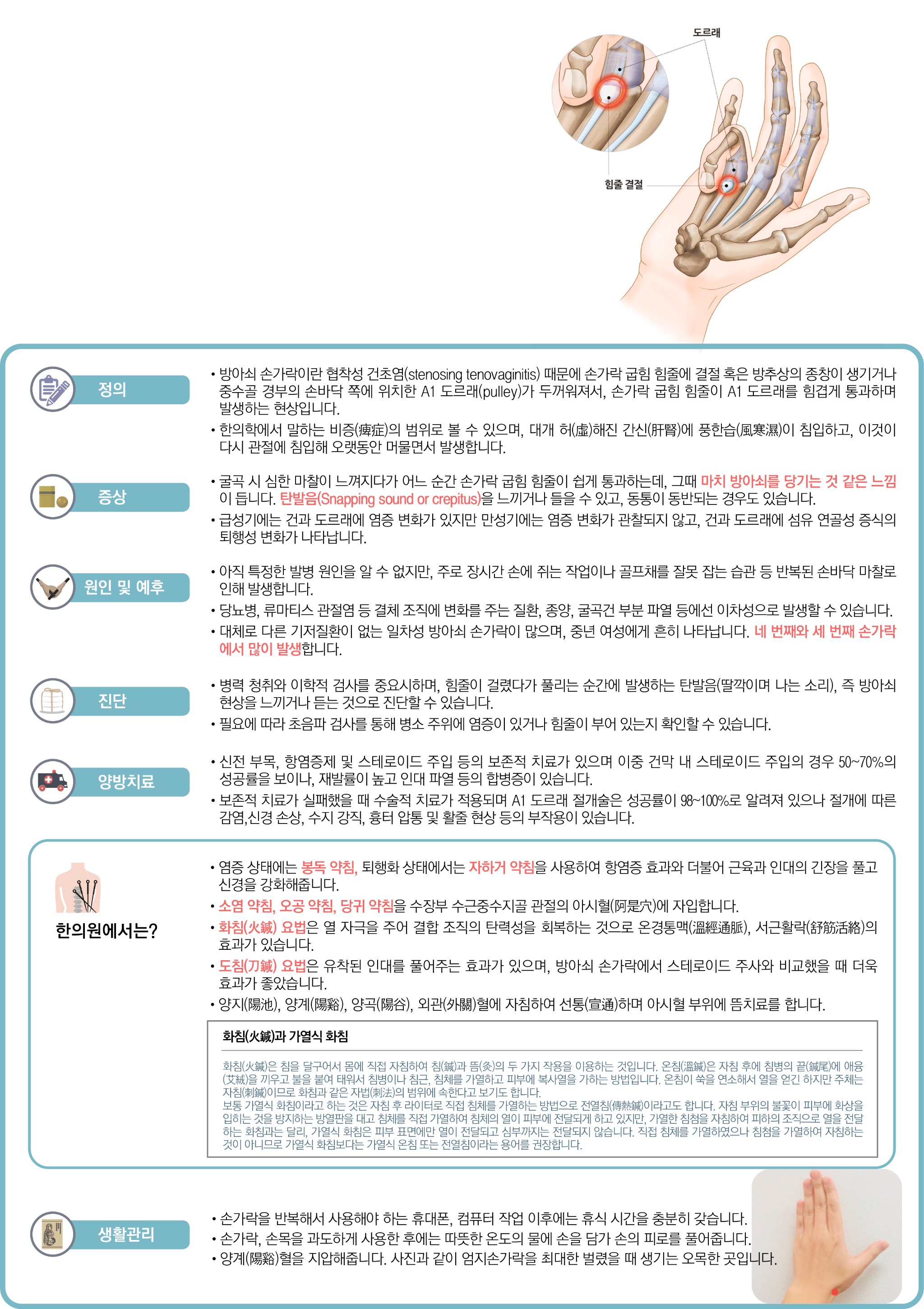 방아쇠손가락 .jpg