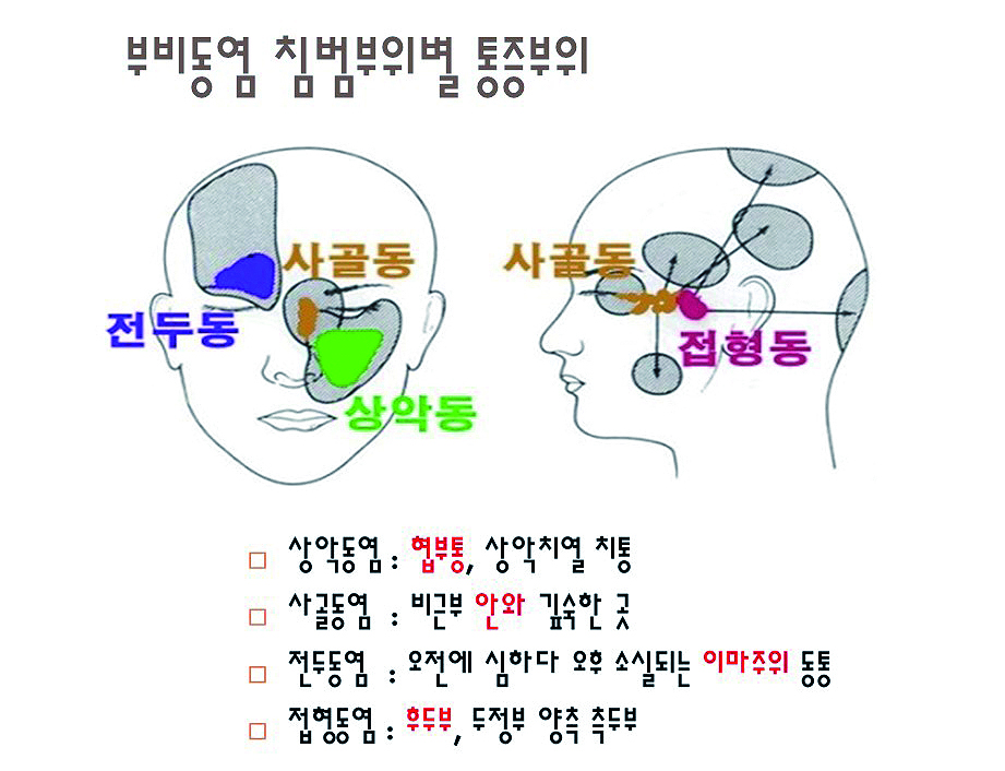 급성 폐쇄성 부비동염_01.JPG