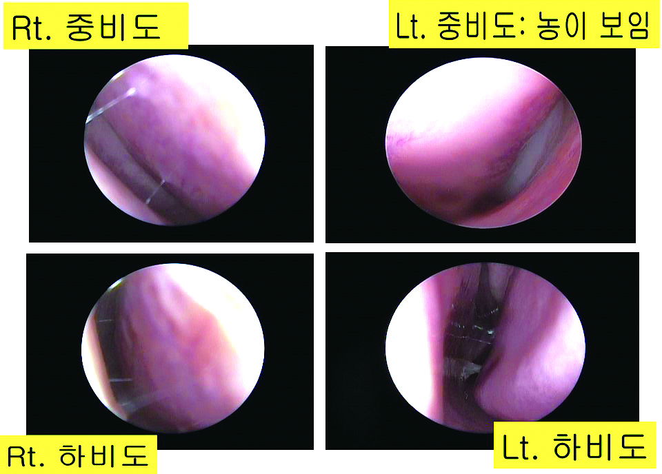 급성 폐쇄성 부비동염_02.JPG