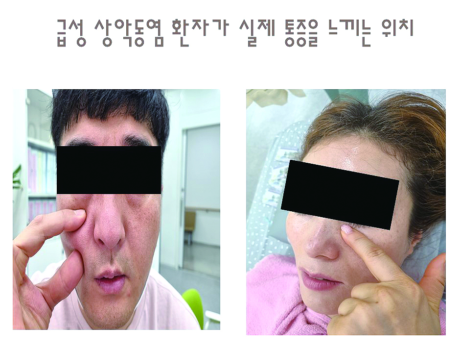 급성 폐쇄성 부비동염_04.JPG