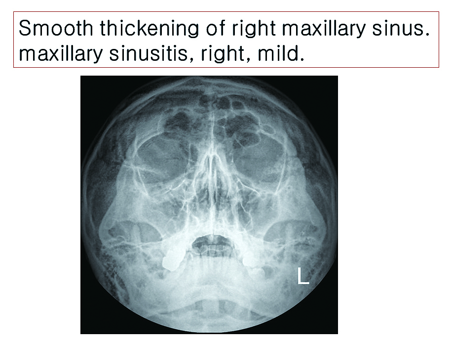 급성 폐쇄성 부비동염_05.JPG