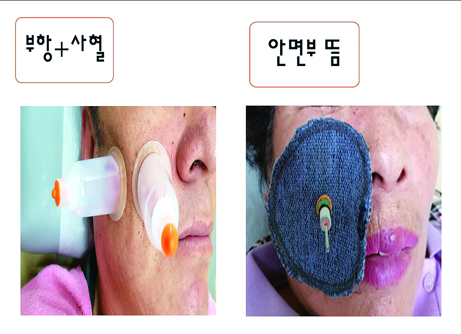 급성 폐쇄성 부비동염_06.JPG