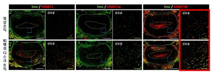 [사진설명] 퇴행이 진행된 디스크의 DNA 메틸화에 DNMT3b 효소가 가장 크게 관여하는 것으로 밝혀졌다..jpg