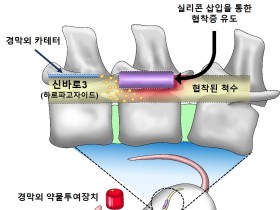 한약재 ‘천수근’ 천연물로 척추관협착증 극복한다