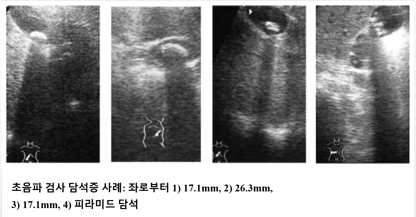 초음파검사 담석증 사례.png