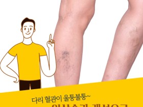 일상습관 개선으로 '하지정맥류' 예방하기!