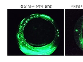 미세먼지가 안과 질환의 주요 원인 입증