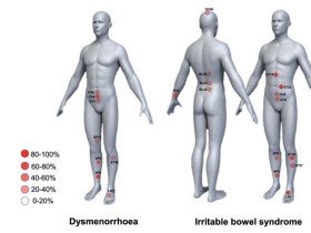 데이터 마이닝 기법으로 통증조절 위한 침 치료 선혈 원리 밝혀내