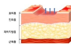 과도한 소독은 오히려 상처 회복 방해해