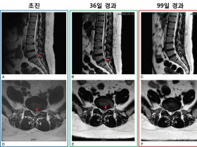 한∙양방 비수술 통합치료로 디스크 낭종 흡수∙통증 지수 호전