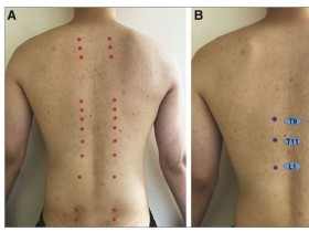 간수·비수·삼초수 혈자리의 자침 심도 및 치료기전 ‘탐색’