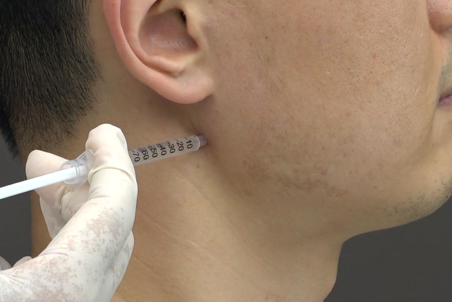 [사진설명] 자생한방병원 의료진이 턱관절질환 약침치료를 실시하고 있다.png