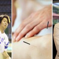 “침 하나로 회복 앞당겨…한의약은 스포츠 재활의 과학”