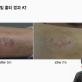 레이저 활용한 비후성 반흔의 치료법 ‘공유’