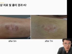 레이저 활용한 비후성 반흔의 치료법 ‘공유’