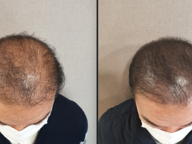 한의 임상에서 시술한 두피 문신 여섯가지 사례