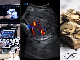 "한약 단독치료로 자궁선근증 호전"…초음파 추적으로 객관 입증