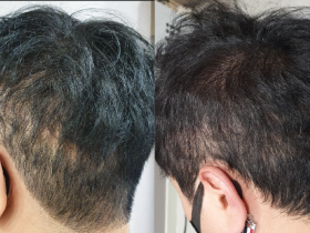 “문신도 의료행위…최근 20년간의 의학 연구 동향 분석”