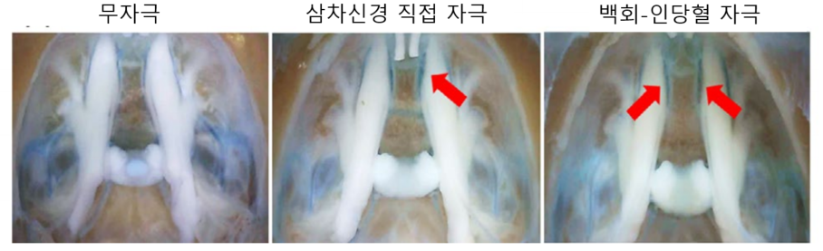 삼차신경4_신경 자극 이미지.png