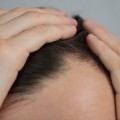탈모 급여 확대에 대한 공론화 논의 중단…비판 여론 의식