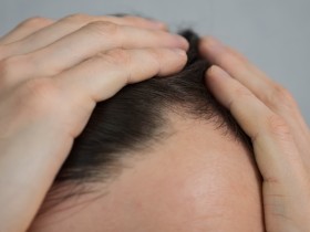 탈모 급여 확대에 대한 공론화 논의 중단…비판 여론 의식