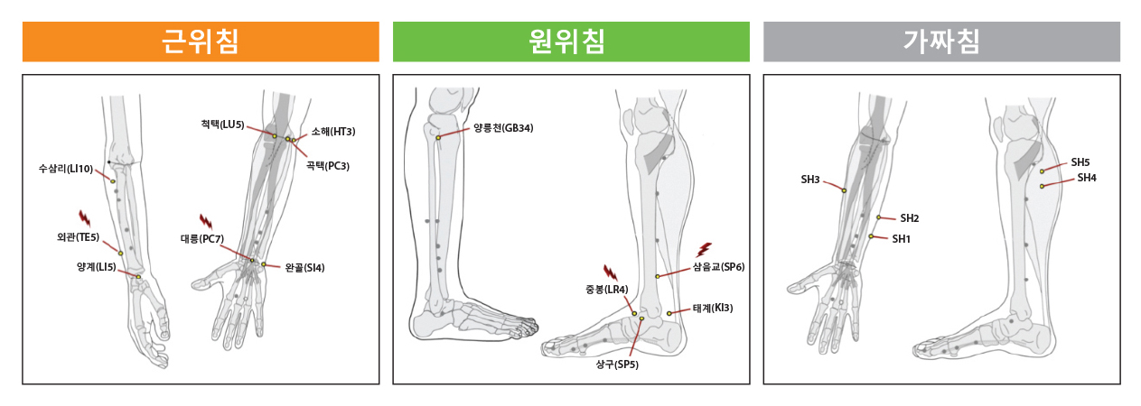 Nightly treatment for carpal tunnel syndrome, which causes the median nerve to be pressed, receiving acupuncture at an oriental medicine clinic in Sunae-dong