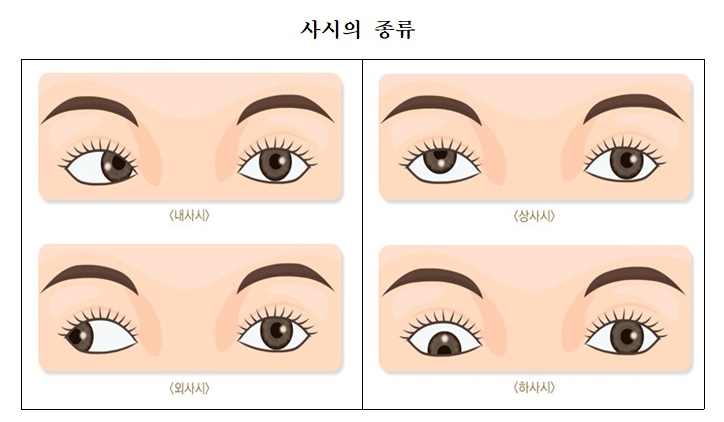 사시